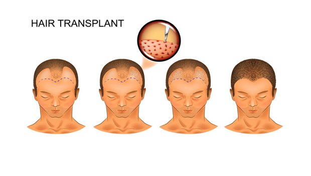 HAIR TRANSPLANTATION OPERATION