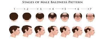 CANDIDATES FOR HAIR TRANSPLANTATION