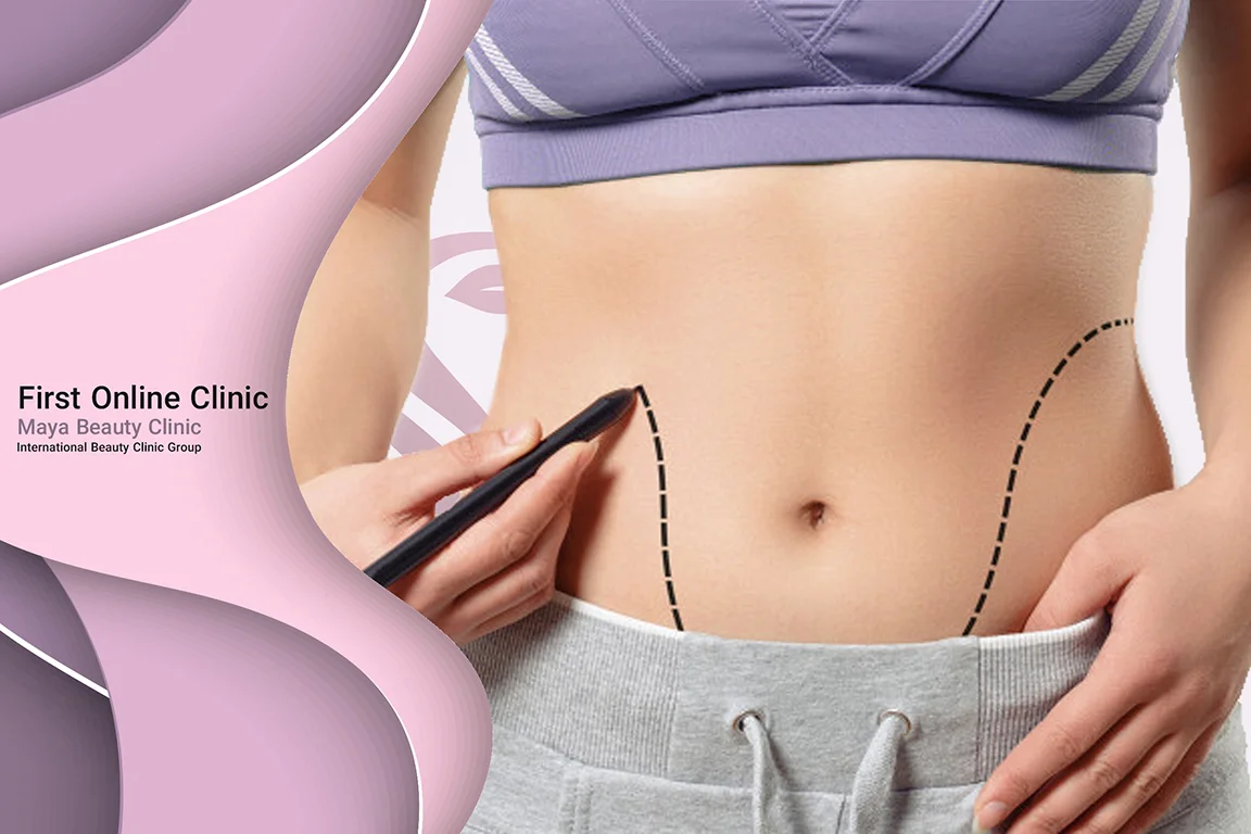 Abdominoplasty